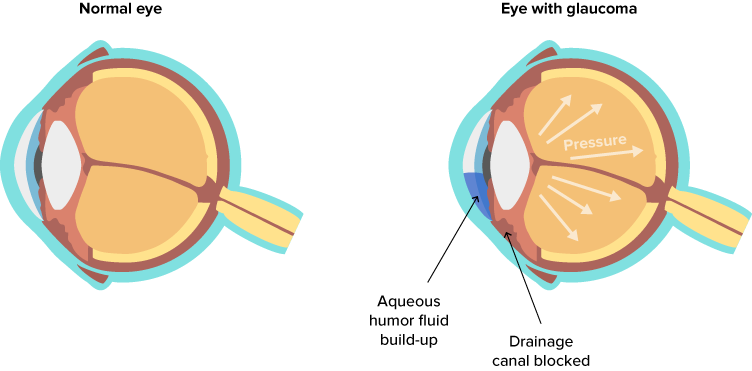 glaucoma eye diagram
