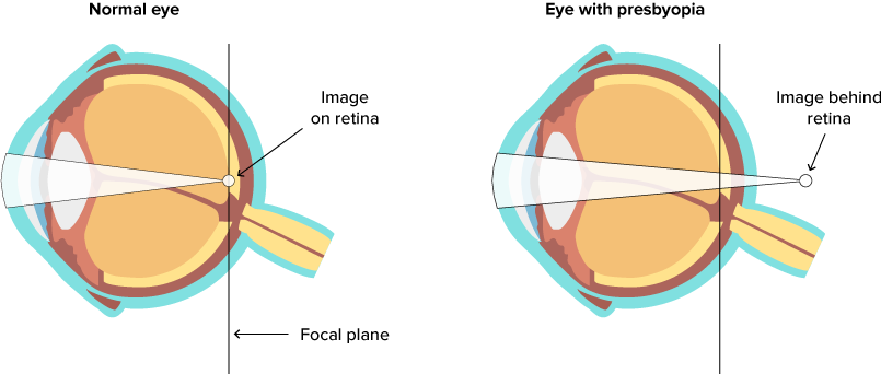 Presbyopia treatment