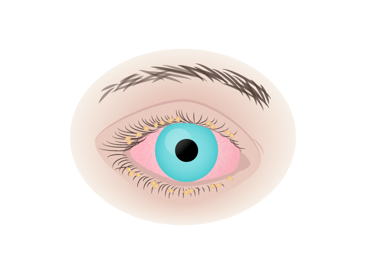 Conjunctivitis diagram