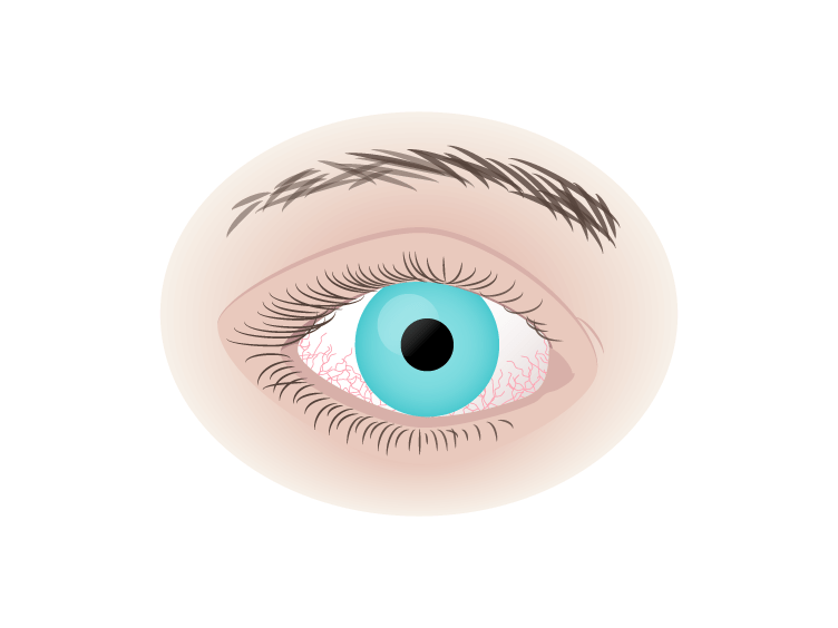 Dry eye diagram