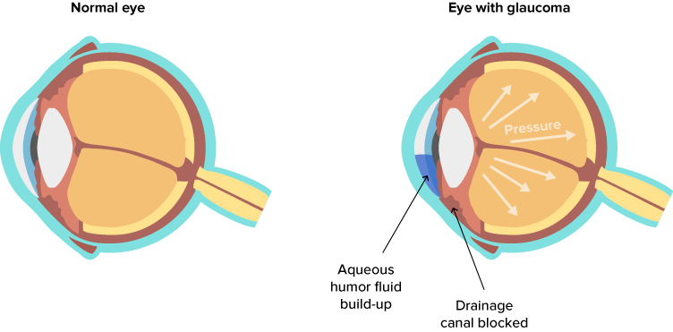 Glaucoma diagram