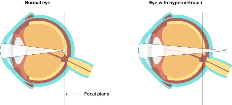 Hypermetropia diagram