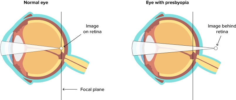 Presbyopia diagram