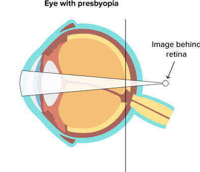 Presbyopia