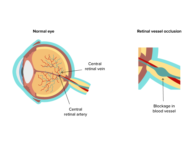 Retinal Vessel Occlusion diagram