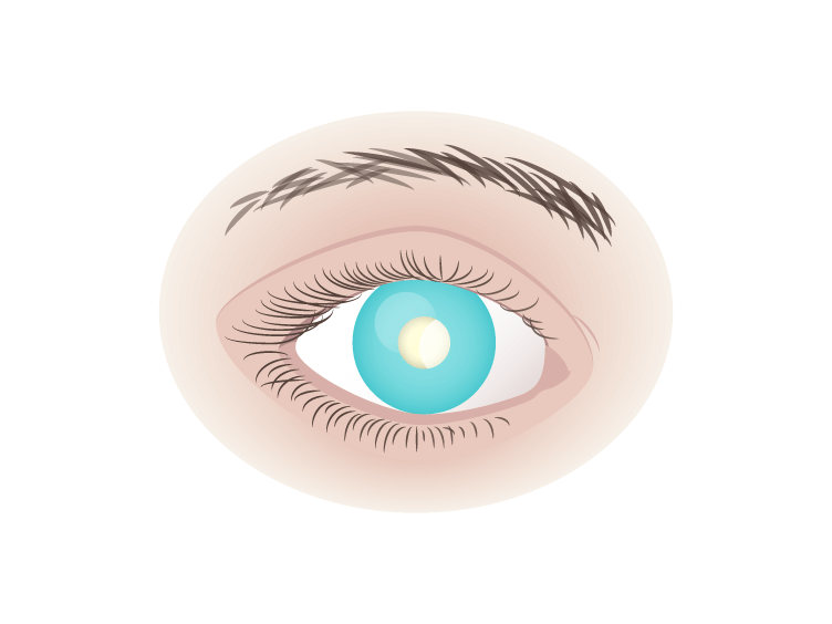 Retinoblastoma diagram
