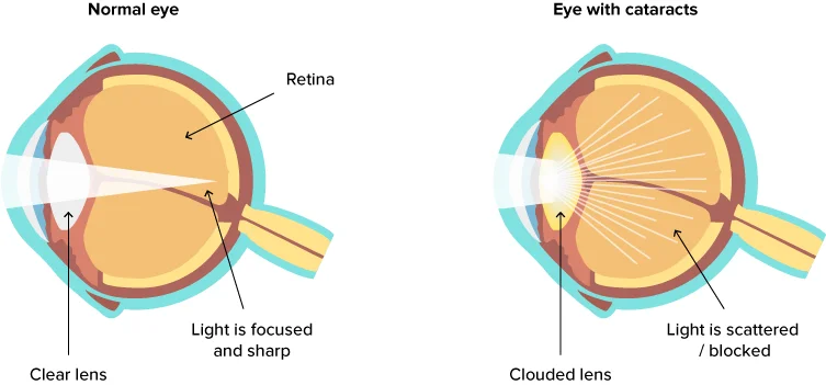 UV Cataracts diagram