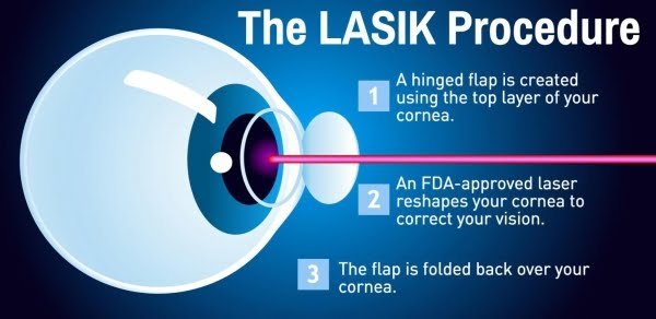 laser-eye-surgery