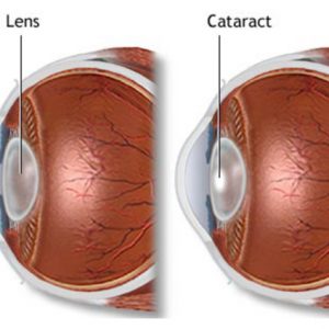 Cataracts and UV